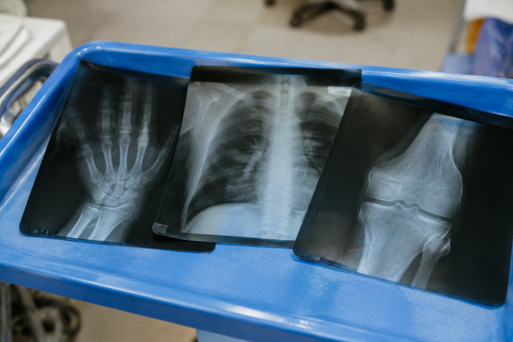 Trois radiographies posees sur un bac bleu hospitalier