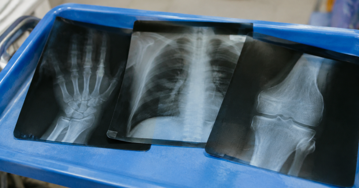 Trois radiographies posees sur un bac bleu hospitalier